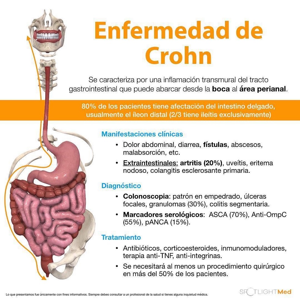 infografia enfermedad de crohn