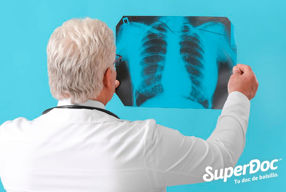 tuberculosis-superdoc
