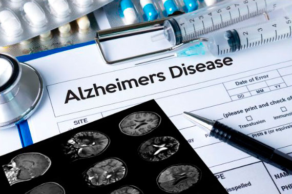 alzheimer disease